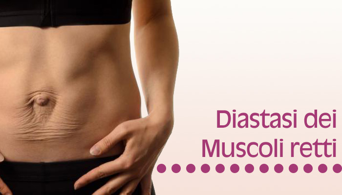 Diastasi dei muscoli retti