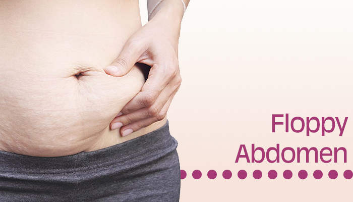 Floppy abdomen
