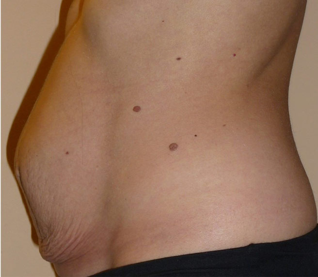 Floppy abdomen dopo due gravidanze
