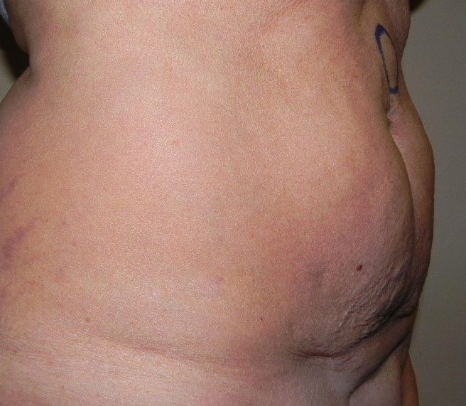 floppy-abdomen1a