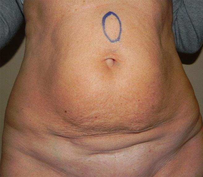 floppy-abdomen1b