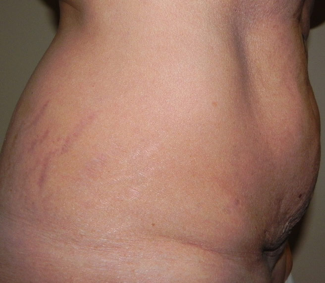 floppy-abdomen1c