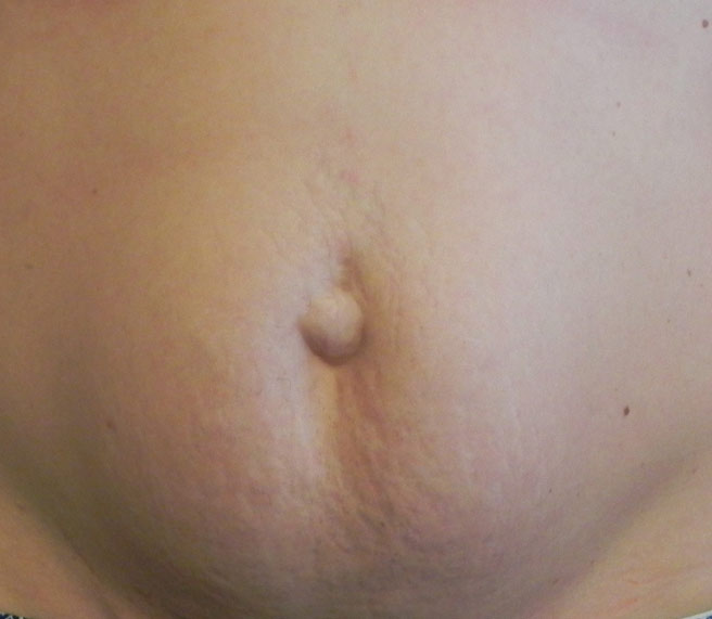 floppy-abdomen2a
