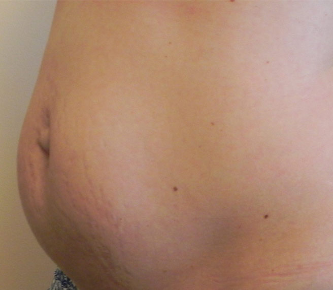 floppy-abdomen2c